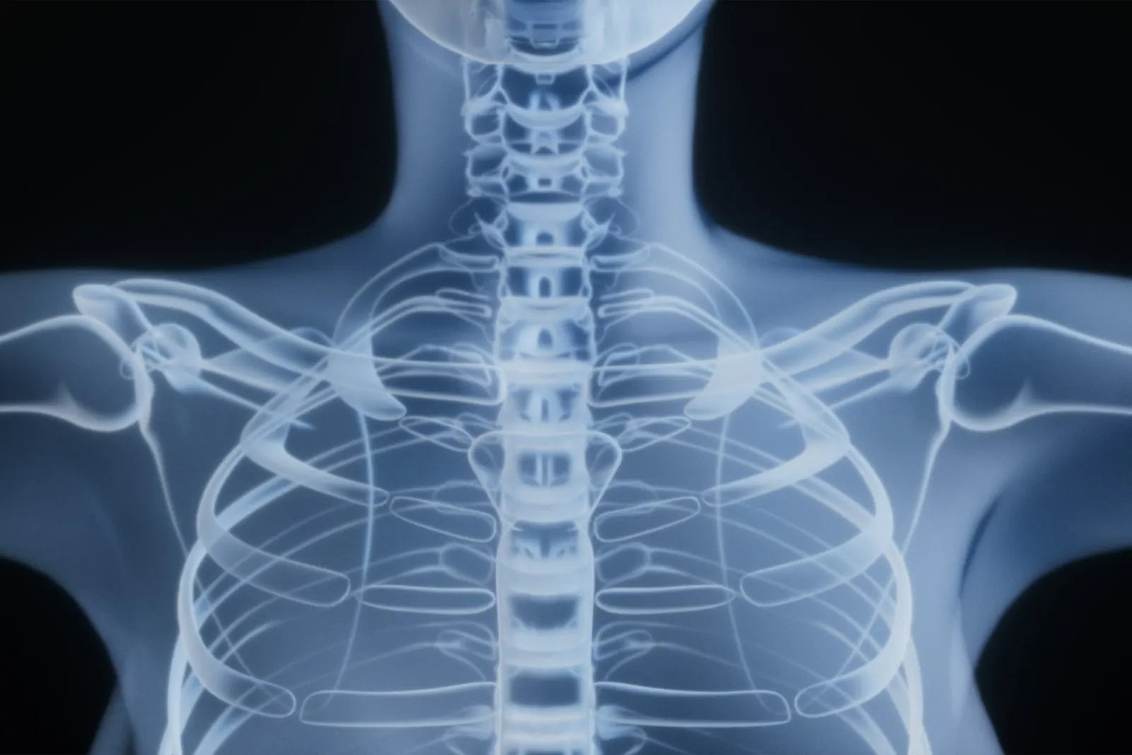 Scoliosis